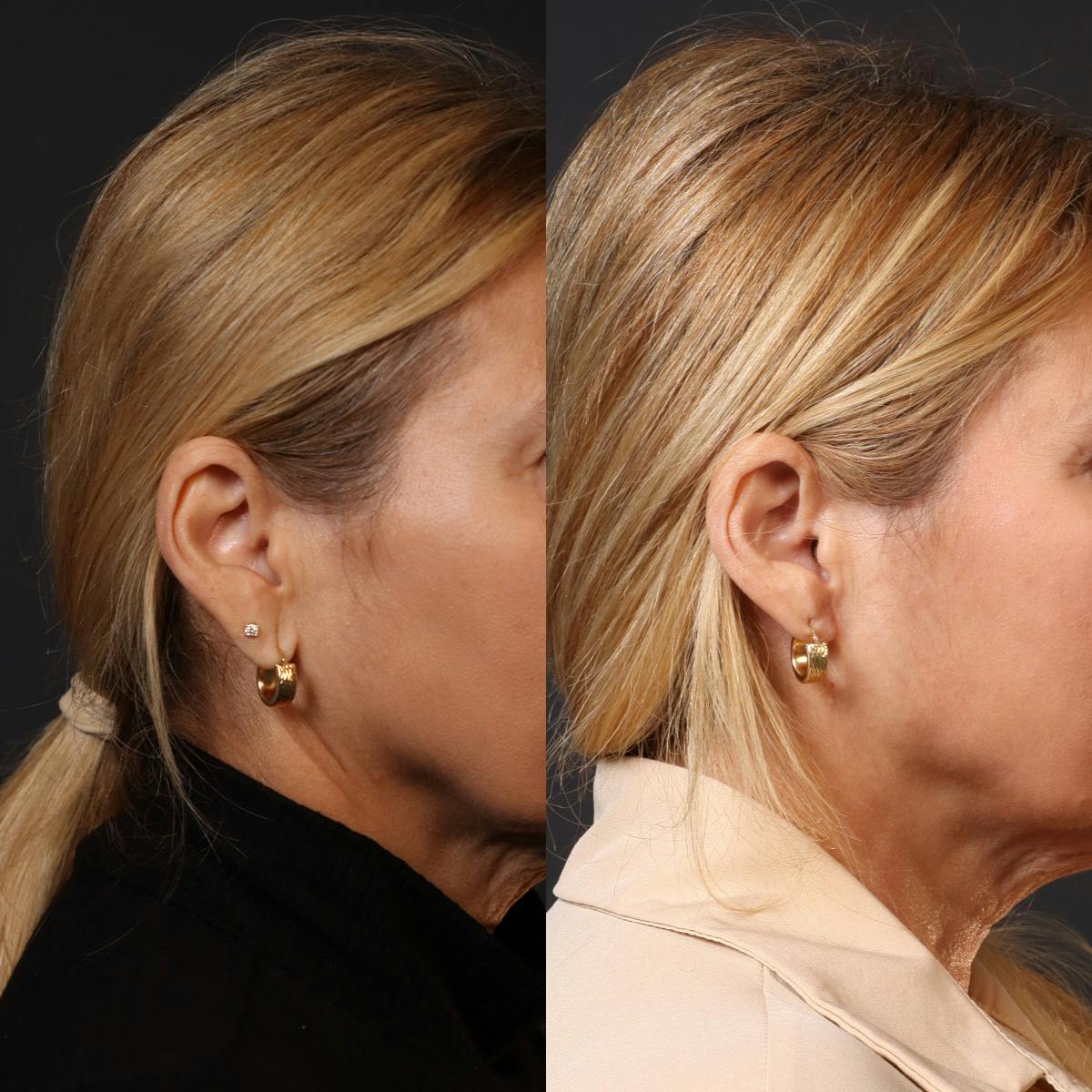 Miami Earlobe Repair Before & After Gallery - Patient 175614 - Image 1 - The Chopra Plastic Surgery Center