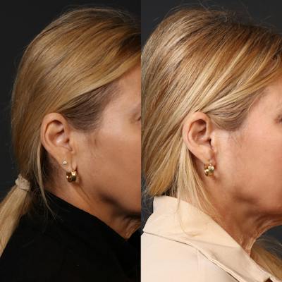 Miami Earlobe Repair Before & After Gallery - Patient 175614 - Image 1 - The Chopra Plastic Surgery Center