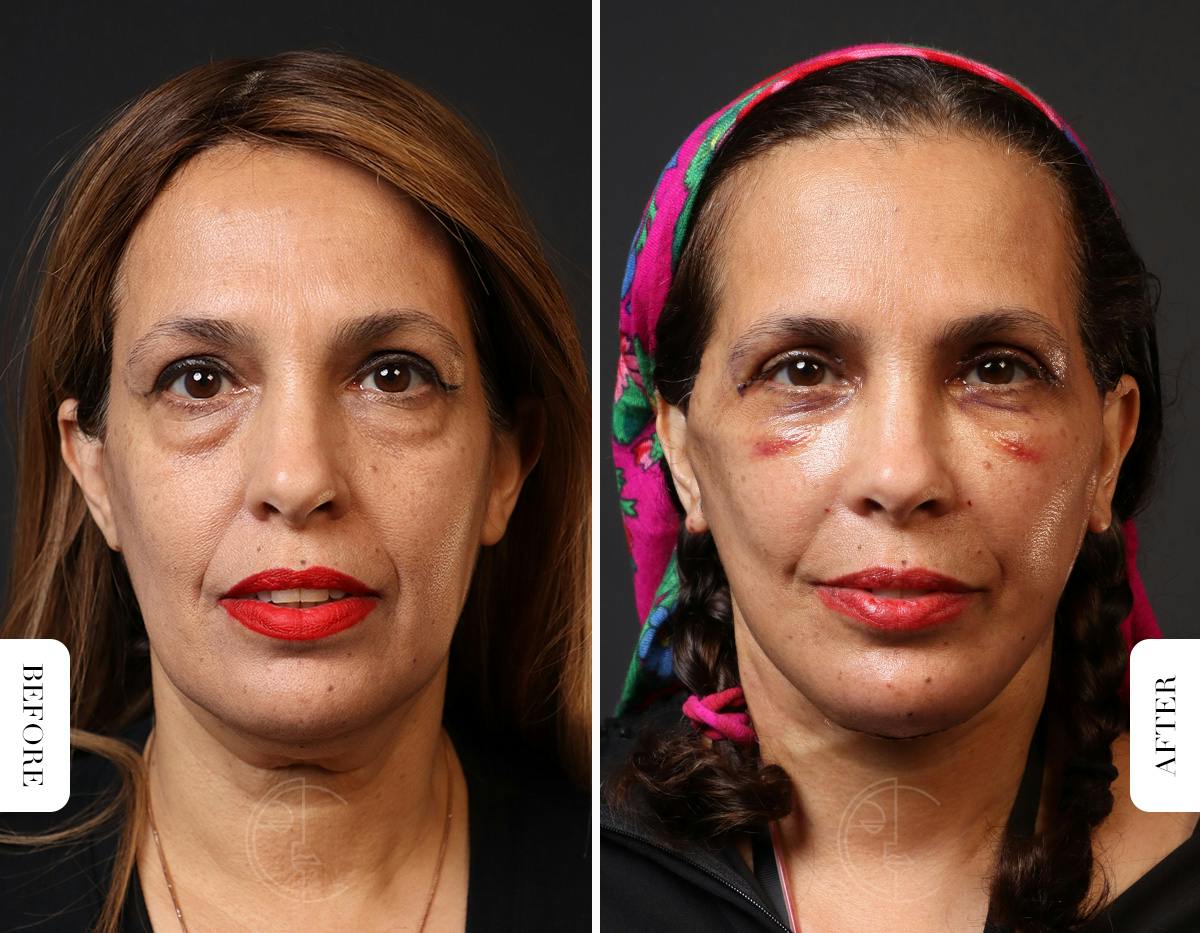 Miami Neck Lift Before & After Gallery - Patient 326585 - Image 2 - The Chopra Plastic Surgery Center