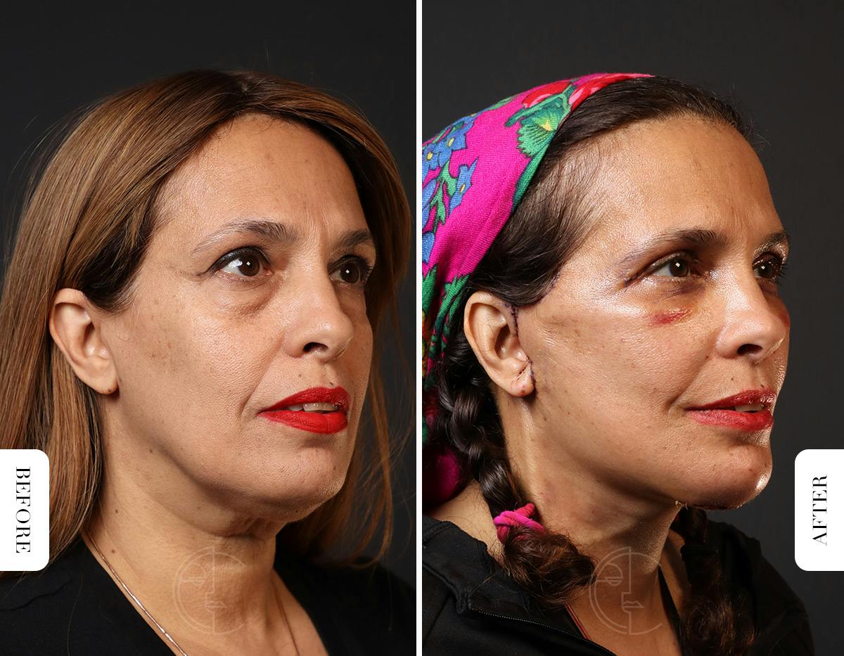 Miami Neck Lift Before & After Gallery - Patient 326585 - Image 1 - The Chopra Plastic Surgery Center