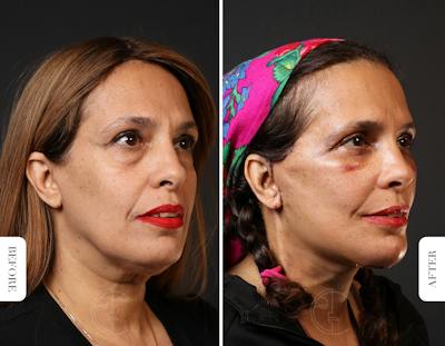 Miami Laser Resurfacing Before & After Gallery - Patient 301236 - Image 1 - The Chopra Plastic Surgery Center