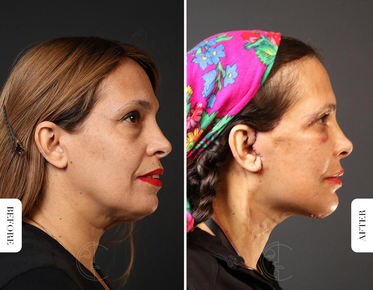 Miami Neck Lift Before & After Gallery - Patient 326585 - Image 3 - The Chopra Plastic Surgery Center