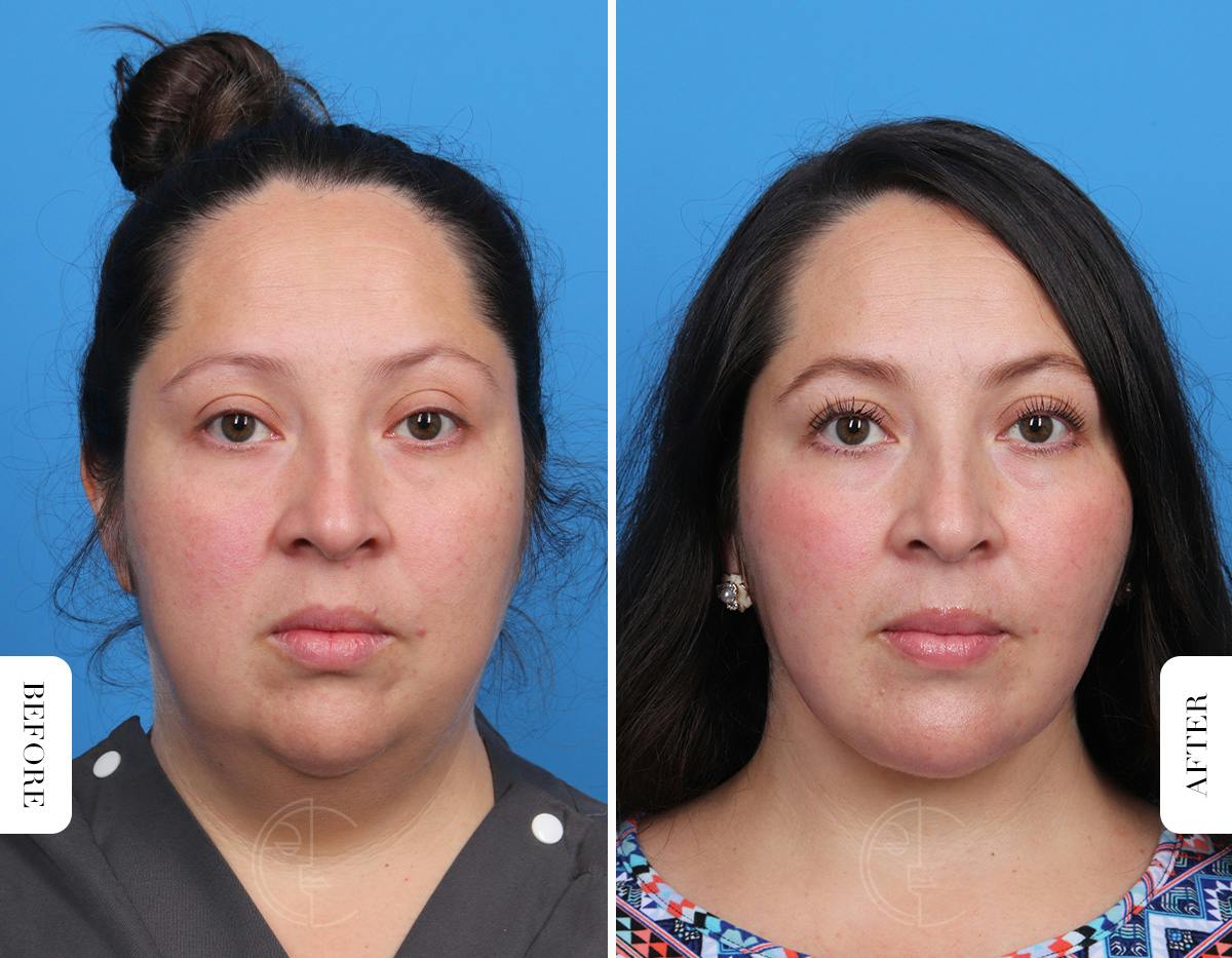 Miami Single-Incision Deep Neck Lift Before & After Gallery - Patient 342814 - Image 5 - The Chopra Plastic Surgery Center