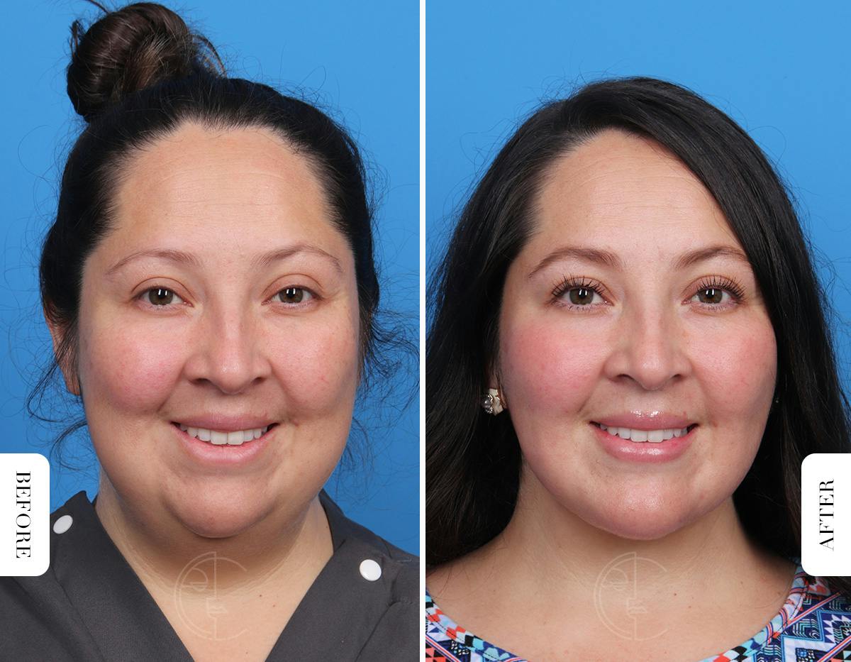 Miami Single-Incision Deep Neck Lift Before & After Gallery - Patient 342814 - Image 6 - The Chopra Plastic Surgery Center
