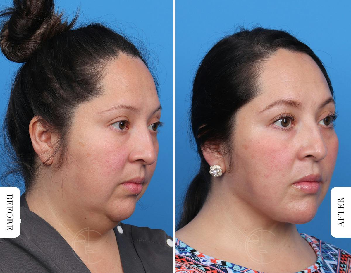 Miami Single-Incision Deep Neck Lift Before & After Gallery - Patient 342814 - Image 4 - The Chopra Plastic Surgery Center