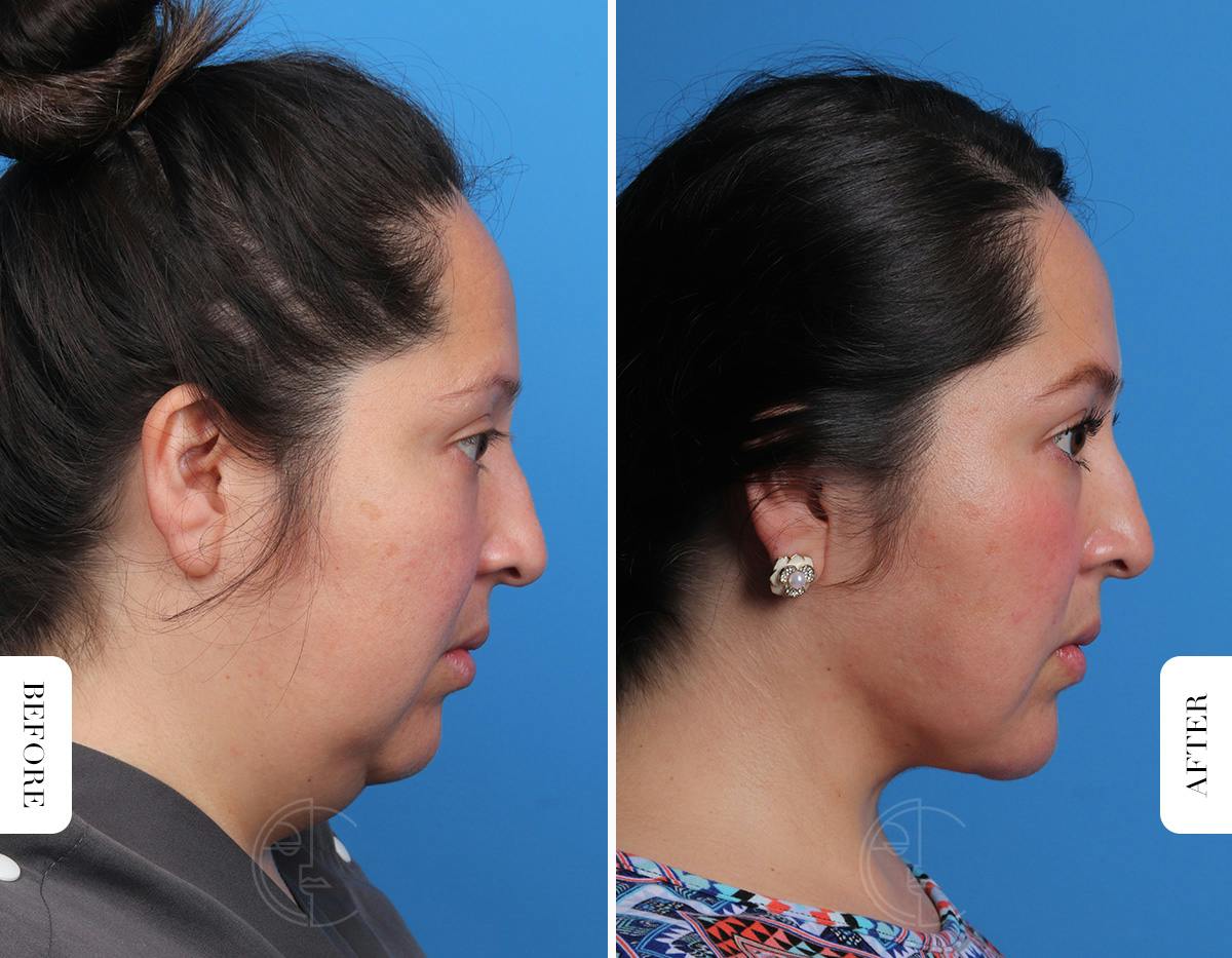 Miami Single-Incision Deep Neck Lift Before & After Gallery - Patient 342814 - Image 3 - The Chopra Plastic Surgery Center