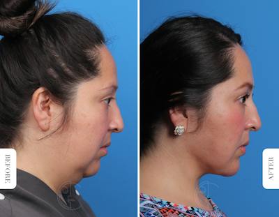 Miami Neck Lift Before & After Gallery - Patient 170192 - Image 1 - The Chopra Plastic Surgery Center