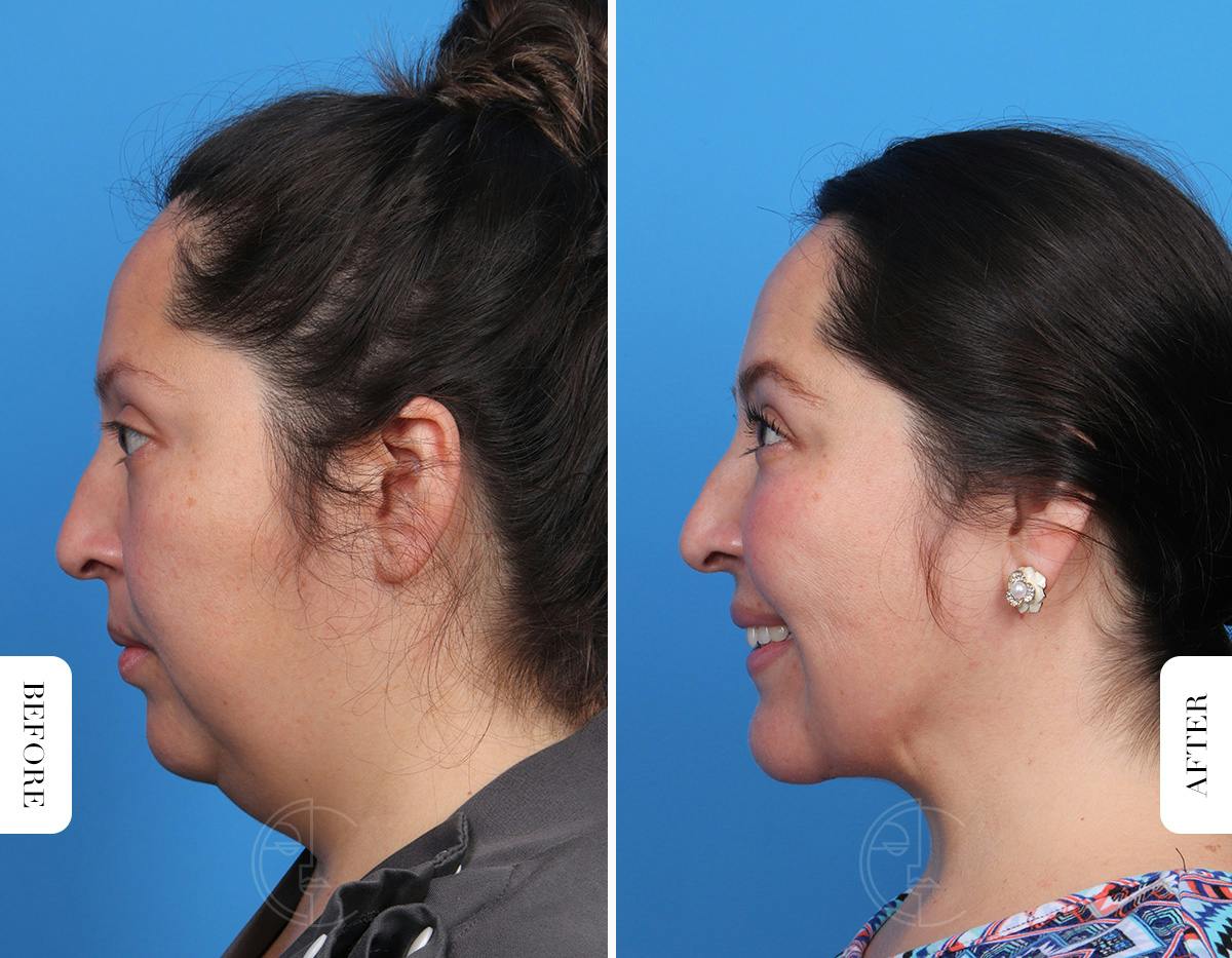 Miami Single-Incision Deep Neck Lift Before & After Gallery - Patient 342814 - Image 1 - The Chopra Plastic Surgery Center