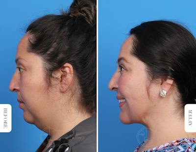 Miami Single-Incision Deep Neck Lift Before & After Gallery - Patient 342814 - Image 1 - The Chopra Plastic Surgery Center
