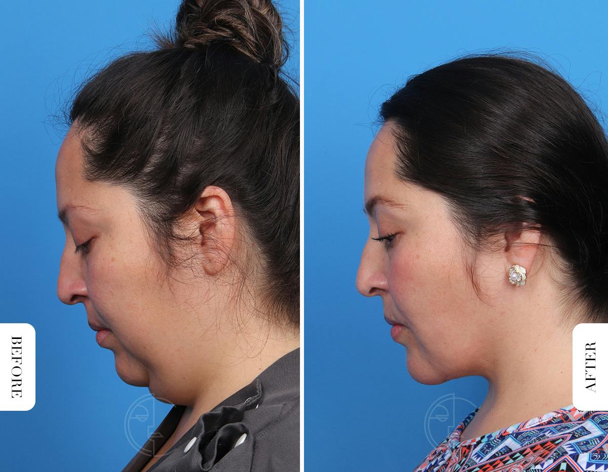 Miami Single-Incision Deep Neck Lift Before & After Gallery - Patient 342814 - Image 2 - The Chopra Plastic Surgery Center