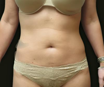 Abdominal Laser Lipo Before & After Gallery - Patient 250015 - Image 1
