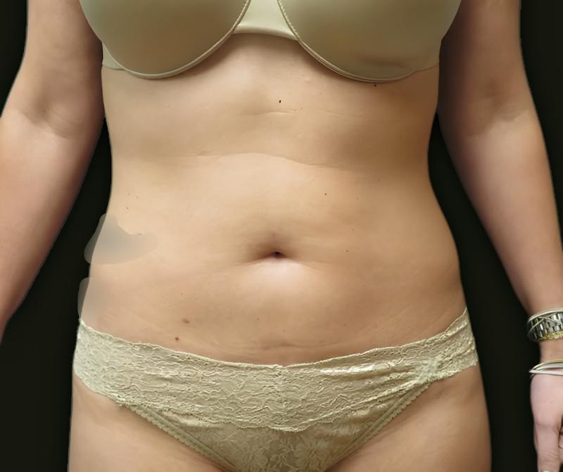 Abdominal Laser Lipo Before & After Gallery - Patient 250015 - Image 1
