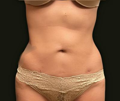 Abdominal Laser Lipo Before & After Gallery - Patient 250015 - Image 2
