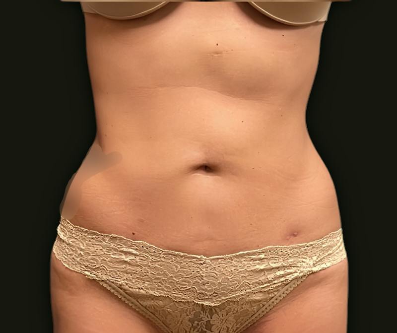 Abdominal Laser Lipo Before & After Gallery - Patient 250015 - Image 2