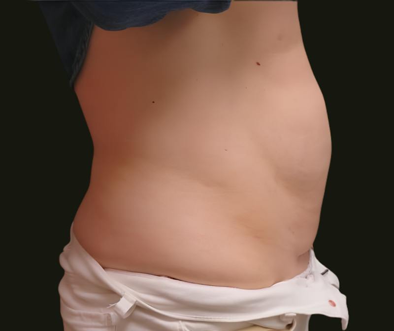 Abdominal Laser Lipo Before & After Gallery - Patient 268474 - Image 3