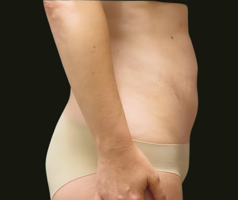 Abdominal Laser Lipo Before & After Gallery - Patient 268474 - Image 4