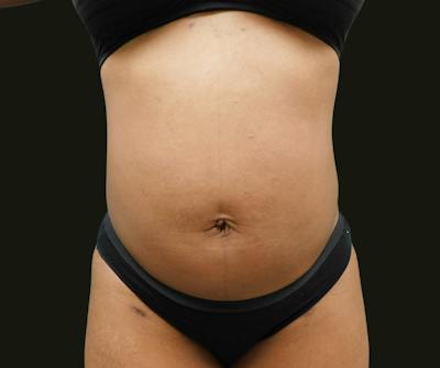 Abdominoplasty Before & After Gallery - Patient 254190 - Image 1