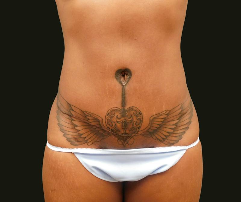 Abdominoplasty Before & After Gallery - Patient 254190 - Image 2