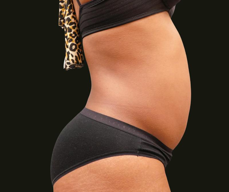 Abdominoplasty Before & After Gallery - Patient 254190 - Image 3