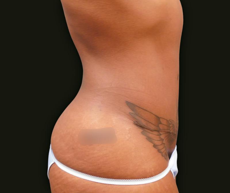 Abdominoplasty Before & After Gallery - Patient 254190 - Image 4