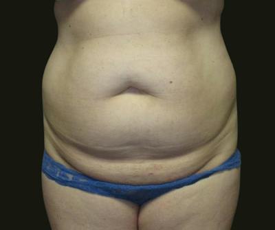 Abdominoplasty Before & After Gallery - Patient 216167 - Image 1