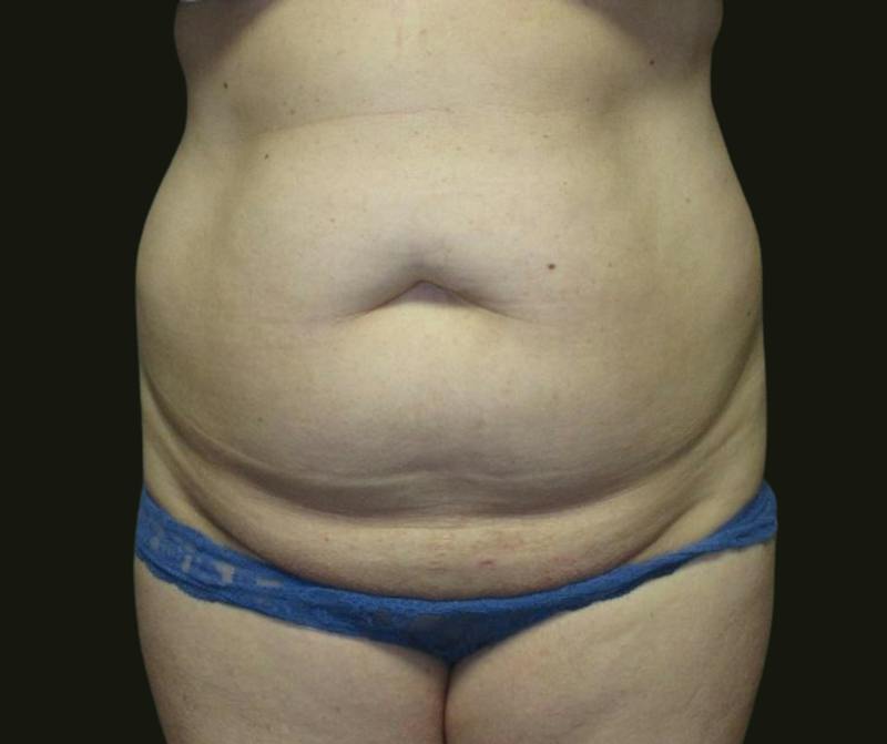 Abdominoplasty Before & After Gallery - Patient 216167 - Image 1