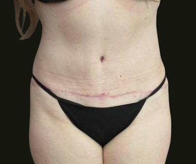 Abdominoplasty Before & After Gallery - Patient 216167 - Image 2