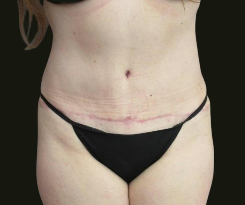 Abdominoplasty Before & After Gallery - Patient 216167 - Image 2