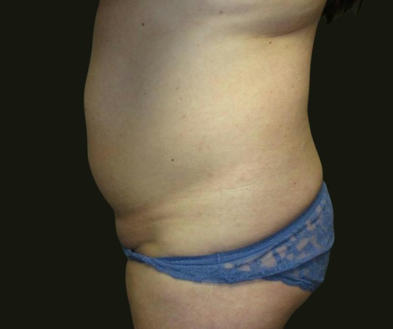 Abdominoplasty Before & After Gallery - Patient 216167 - Image 3