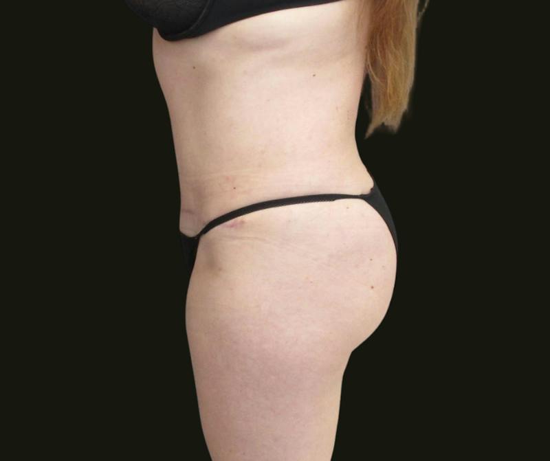 Abdominoplasty Before & After Gallery - Patient 216167 - Image 4