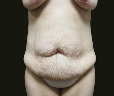 Abdominoplasty Before & After Gallery - Patient 190423 - Image 1