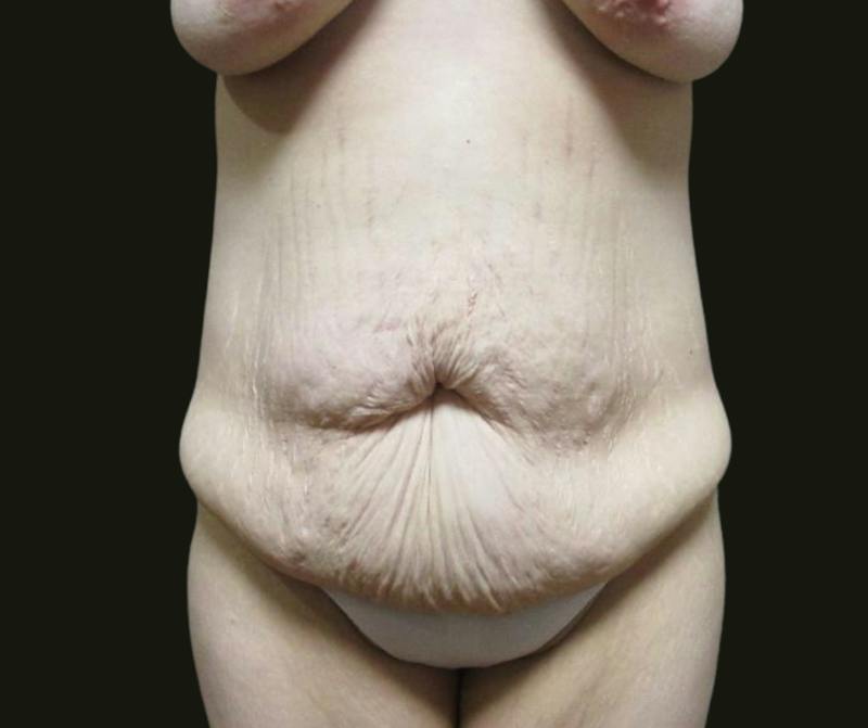 Abdominoplasty Before & After Gallery - Patient 190423 - Image 1