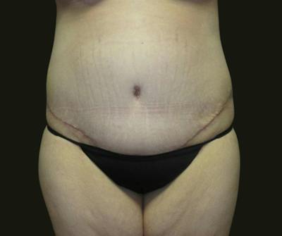 Abdominoplasty Before & After Gallery - Patient 190423 - Image 2