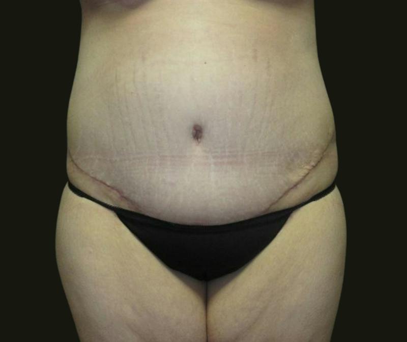 Abdominoplasty Before & After Gallery - Patient 190423 - Image 2