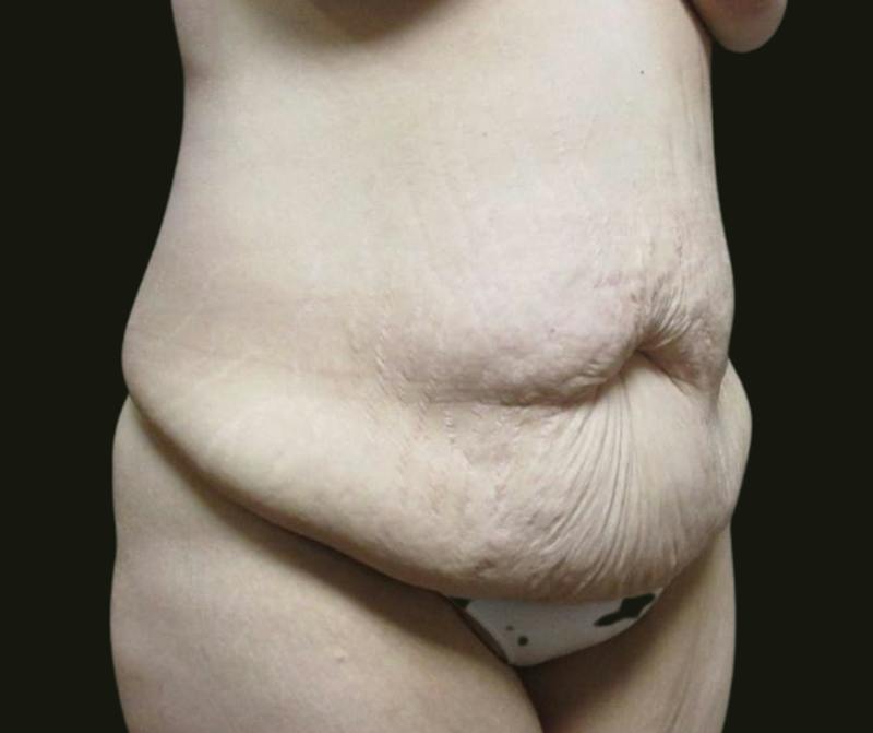 Abdominoplasty Before & After Gallery - Patient 190423 - Image 3