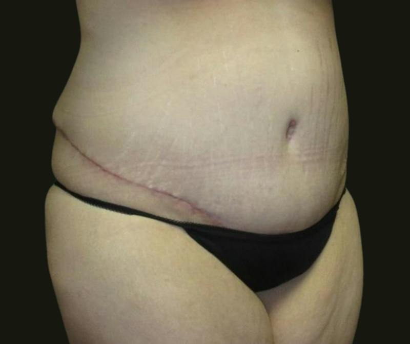 Abdominoplasty Before & After Gallery - Patient 190423 - Image 4