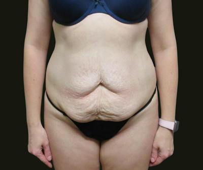 Abdominoplasty Before & After Gallery - Patient 334429 - Image 1