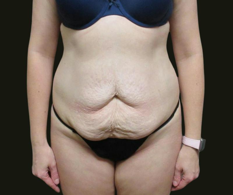 Abdominoplasty Before & After Gallery - Patient 334429 - Image 1
