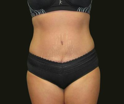 Abdominoplasty Before & After Gallery - Patient 334429 - Image 2