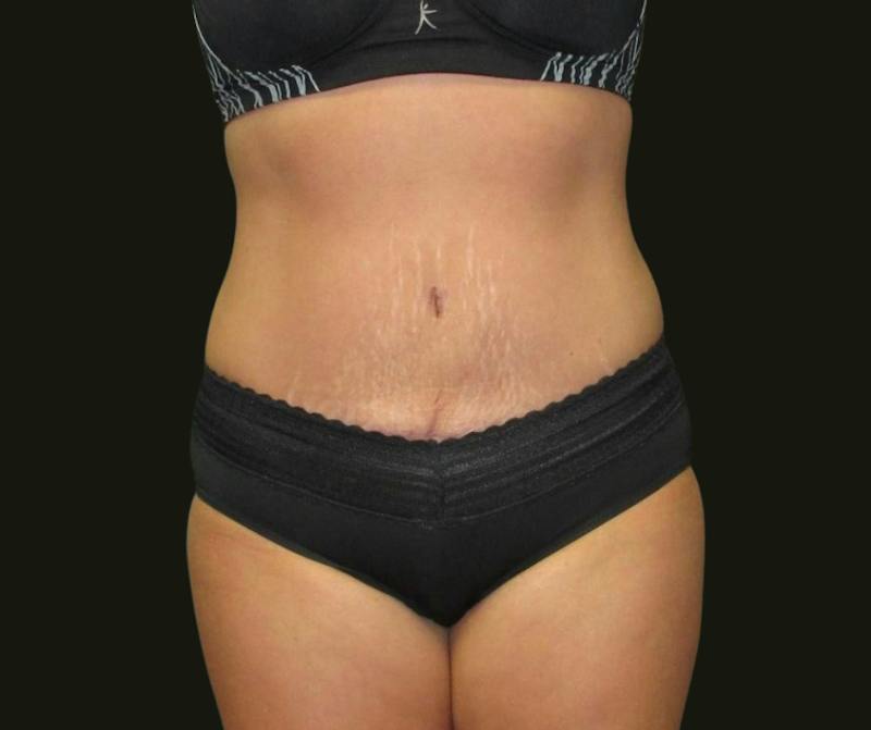 Abdominoplasty Before & After Gallery - Patient 334429 - Image 2
