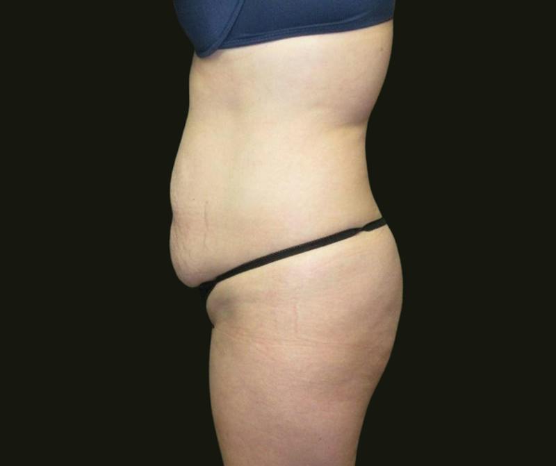 Abdominoplasty Before & After Gallery - Patient 334429 - Image 3