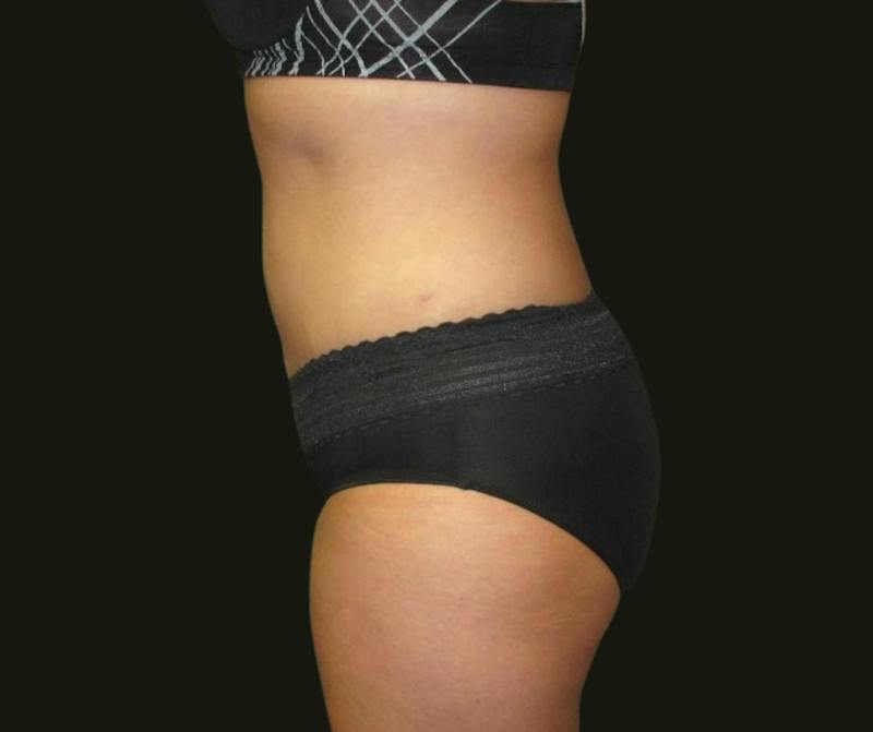 Abdominoplasty Before & After Gallery - Patient 334429 - Image 4