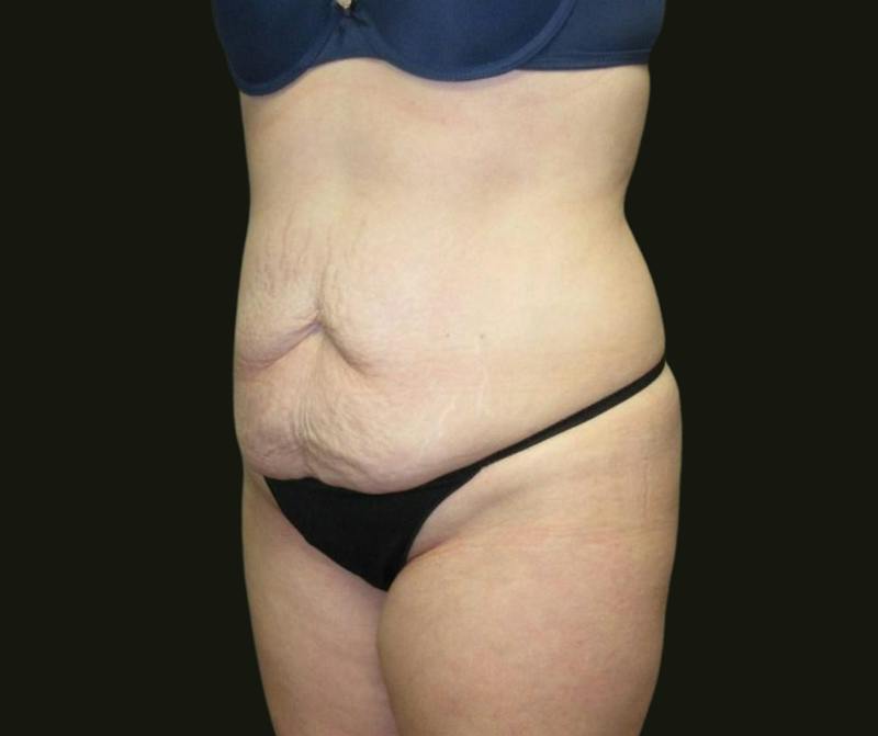 Abdominoplasty Before & After Gallery - Patient 334429 - Image 5