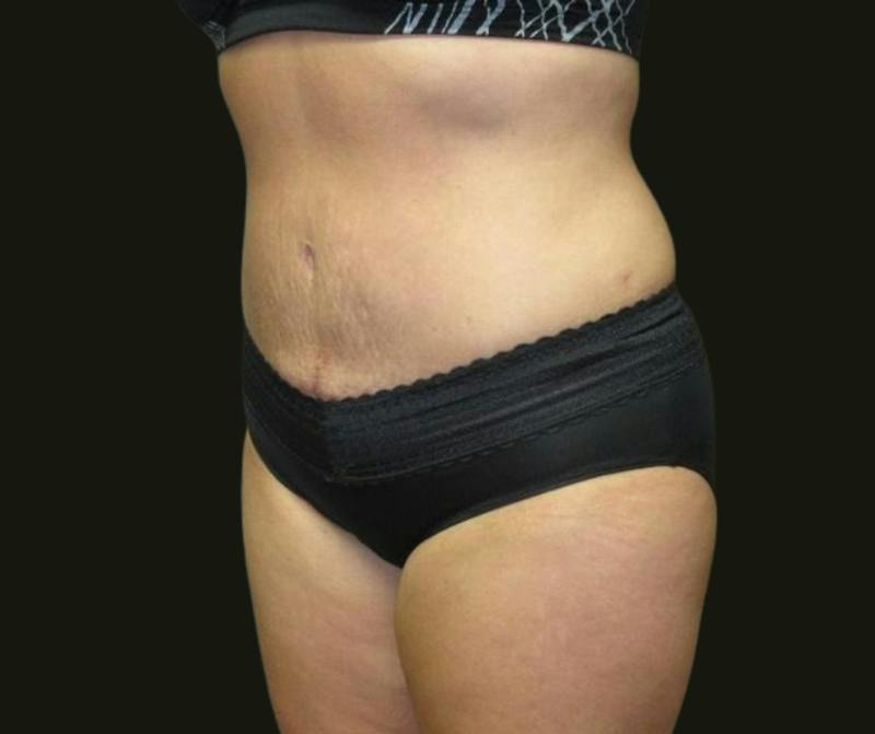 Abdominoplasty Before & After Gallery - Patient 334429 - Image 6