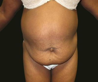 Abdominoplasty Before & After Gallery - Patient 211150 - Image 1