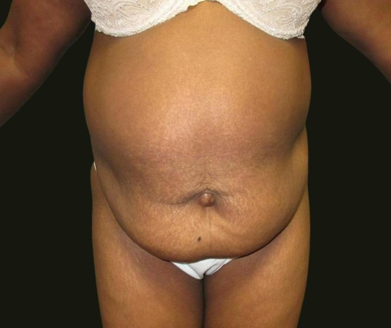 Abdominoplasty Before & After Gallery - Patient 211150 - Image 1