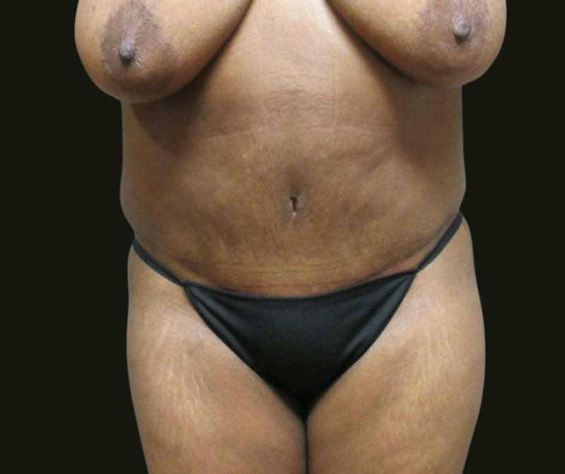 Abdominoplasty Before & After Gallery - Patient 211150 - Image 2