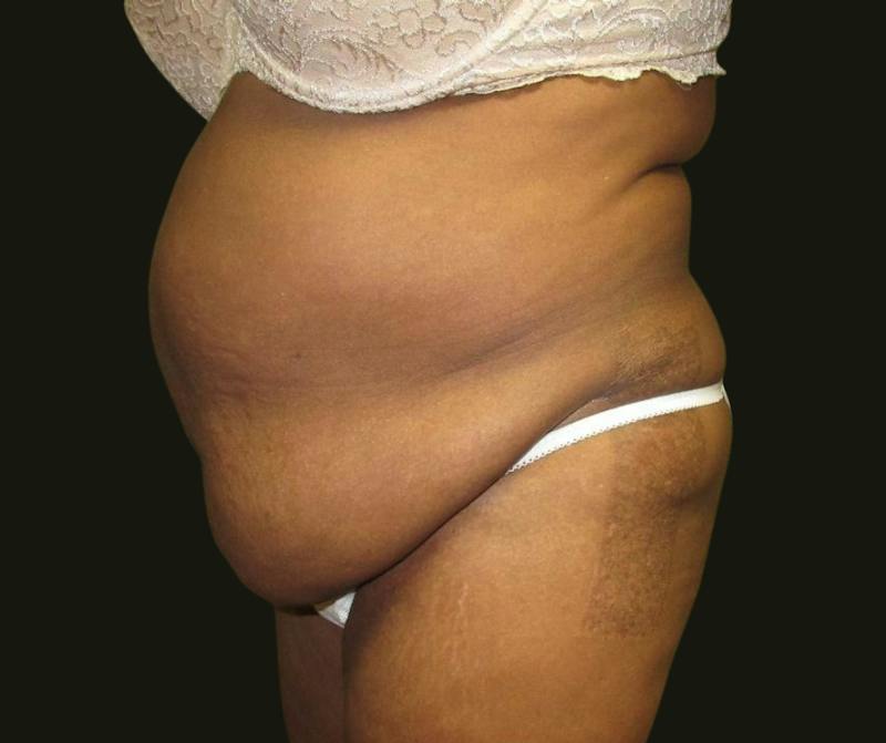 Abdominoplasty Before & After Gallery - Patient 211150 - Image 3