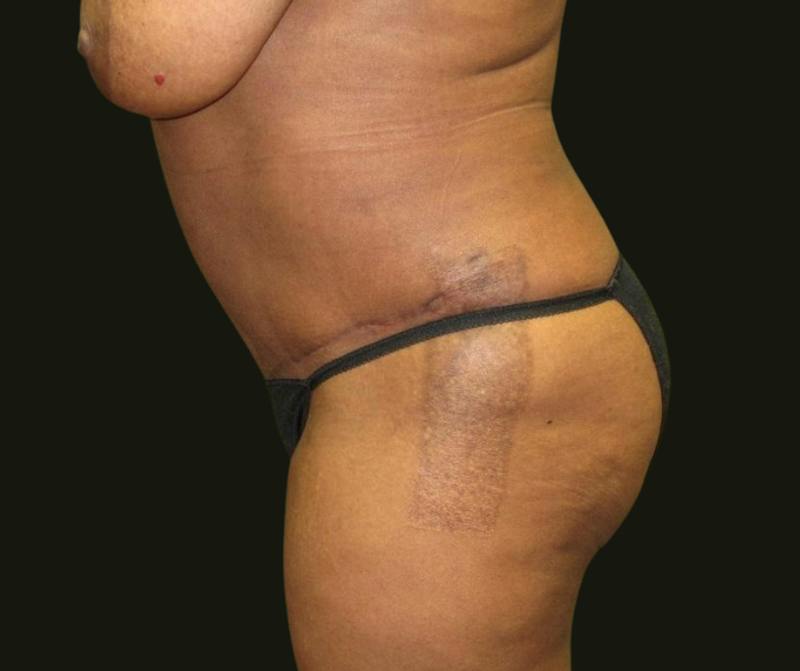 Abdominoplasty Before & After Gallery - Patient 211150 - Image 4