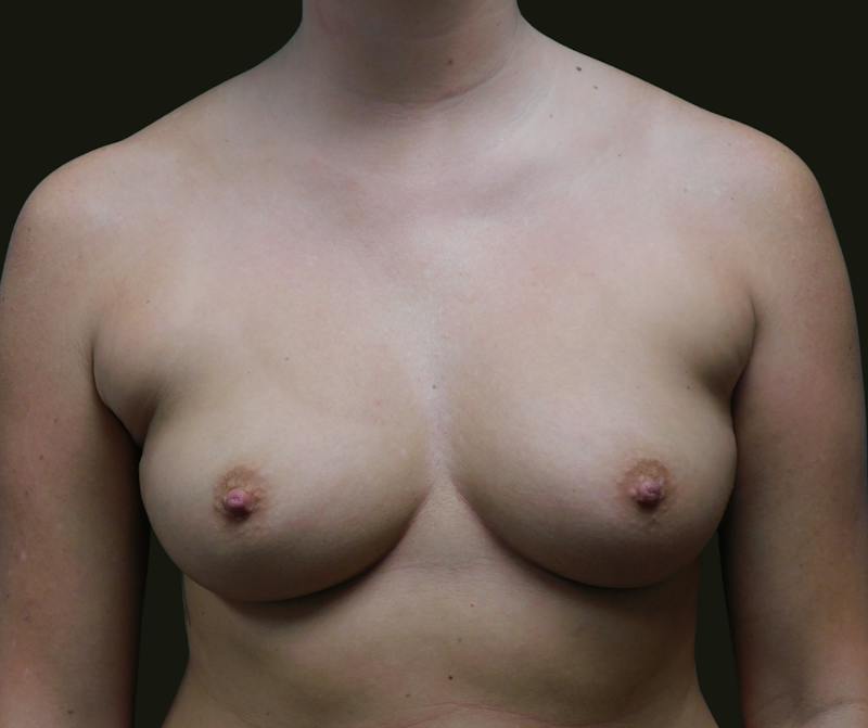 Breast Augmentation Before & After Gallery - Patient 121343 - Image 1